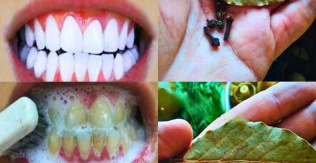 Sbiancare i denti facilmente