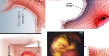 cancro allo stomaco segnali
