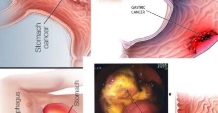 cancro allo stomaco segnali