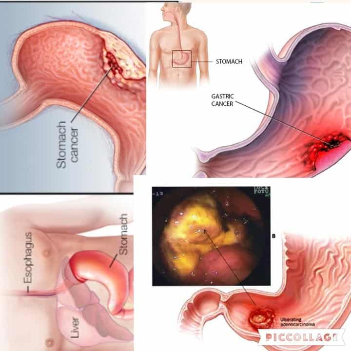 cancro allo stomaco segnali