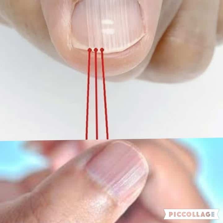 linee verticali sulle unghie