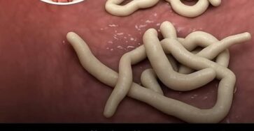 parassiti nel corpo