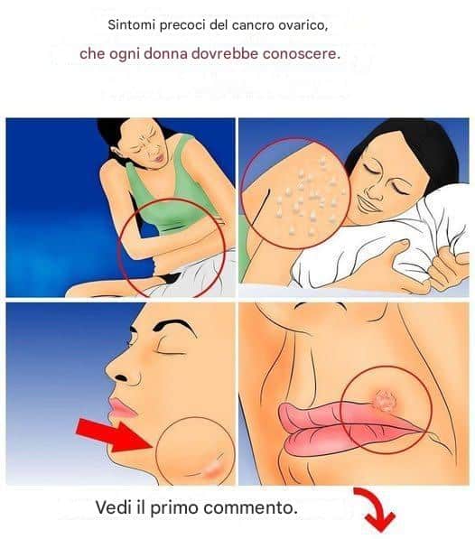 sintomi tumore ovarico precoci
