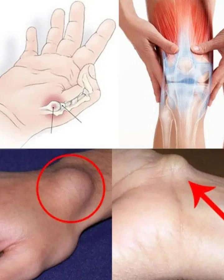 cisti al piede rimedi