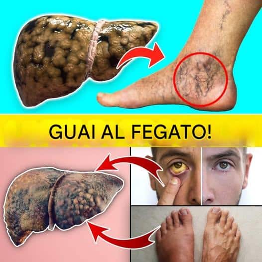 segnali fegato difficoltà