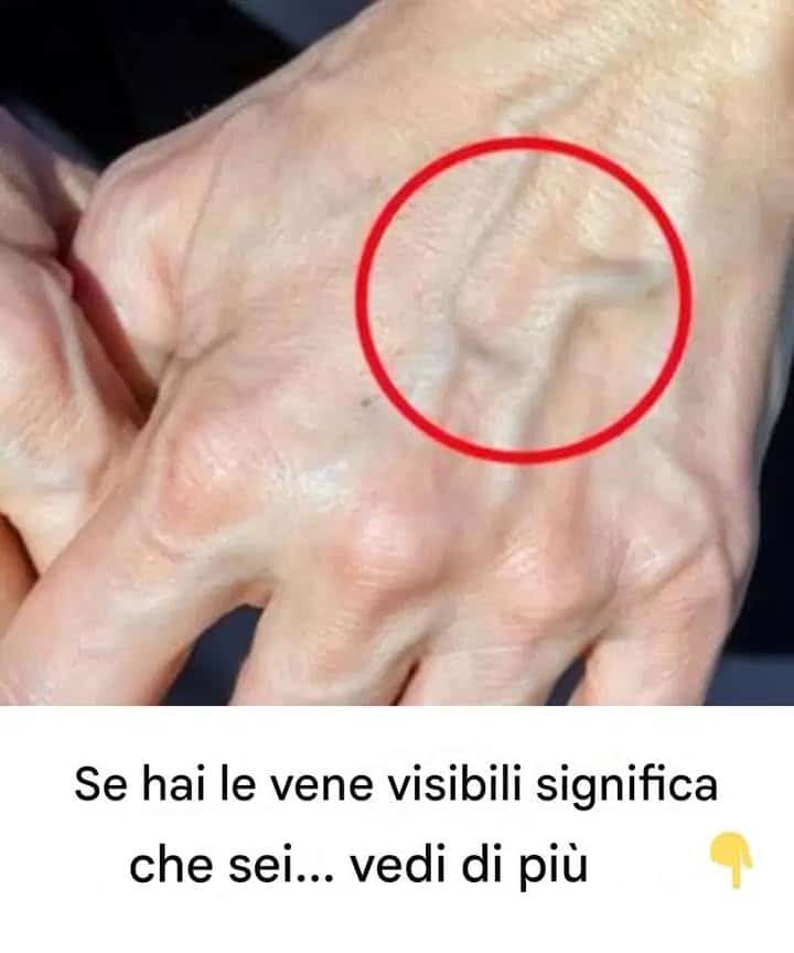 vene apparenti preoccupazione