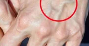 vene visibili salute e bellezza